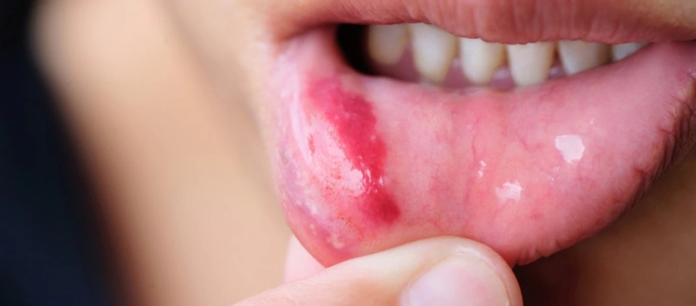 Ποια τα συμπτώματα του καρκίνου του στόματος;